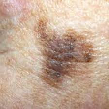 Melanoma Maligna